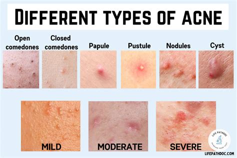 5 Types of Acne Scars and How to Treat Them